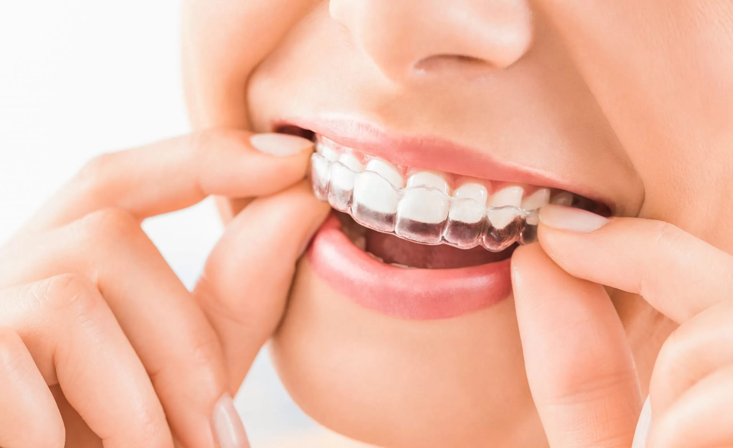Alinhador transparente Invisalign sendo encaixado no sorriso